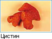 Цистинови камъни в бъбреците