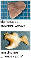 Инфекциозни камъни в бъбреците
