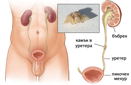 Симптоми при бъбречно-каменна болест - БОЛКА